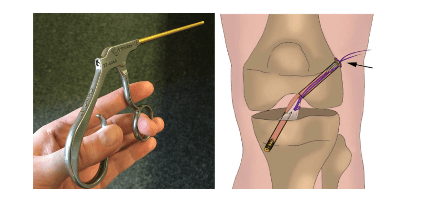 the suture cutter the suture cutter